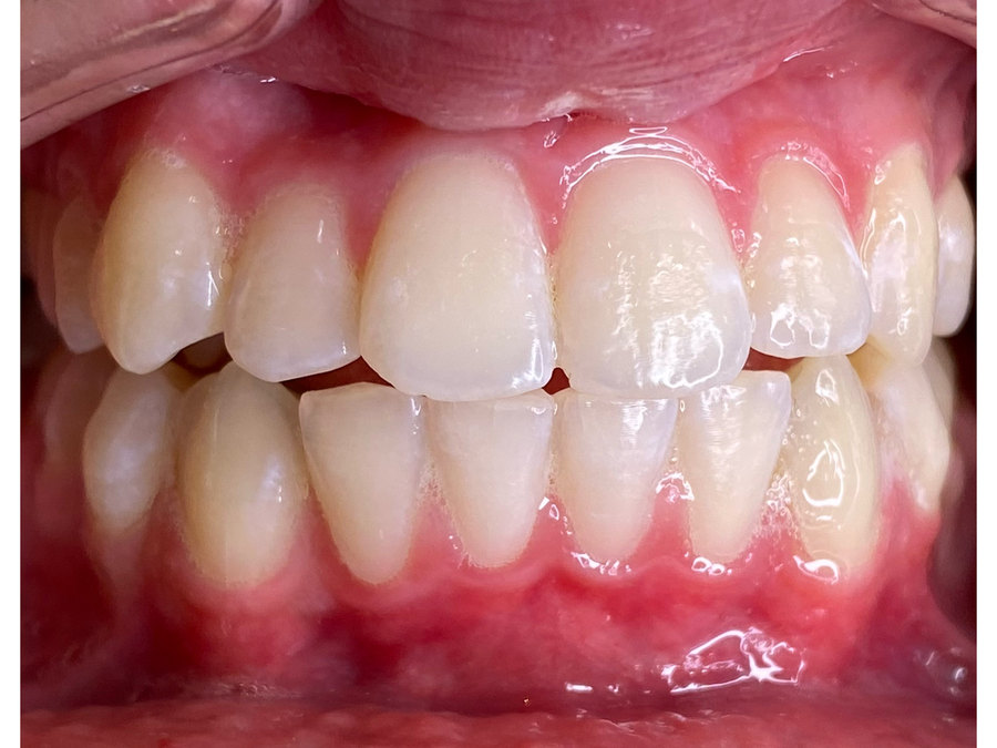 The same client's teeth after one session