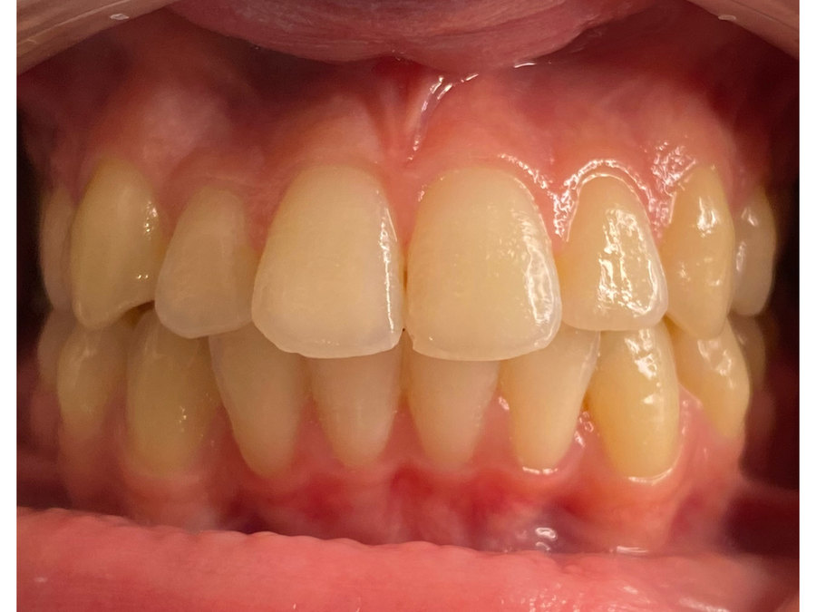 A client's teeth before the whitening session