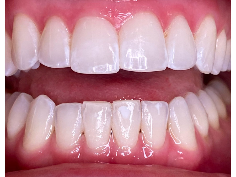 The same client's teeth after one session