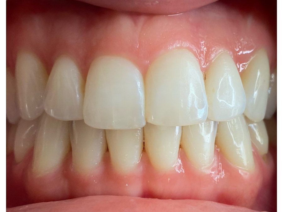 A second client's teeth before the whitening session
