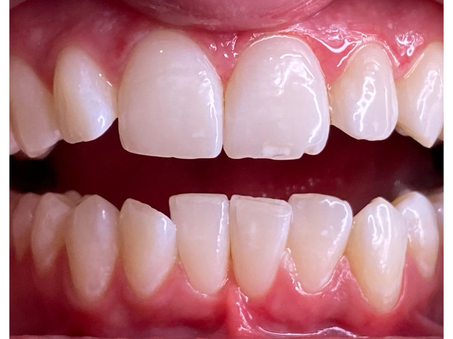 The same client's teeth after one session