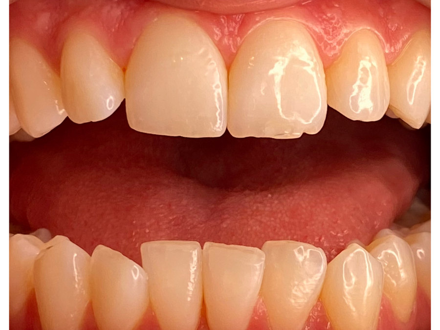 A third client's teeth before the whitening session